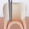 Dental Spur Endodontic Safe End