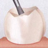 Preparation - Inverted Dental Spur