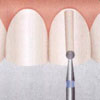 Dental Spur Preparation - Round